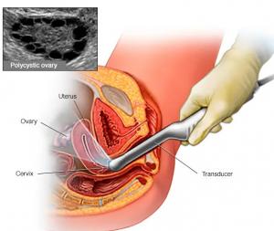  Polycystic Ovary Syndrome (PCOS) Treatment Market