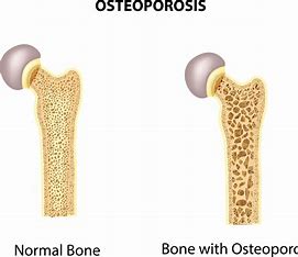 Worldwide, up to 37 million fragility fractures occur annually in individuals aged over 55