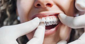 Invisalign Costa Mesa