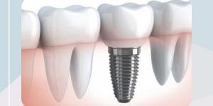Bio-Implants