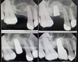 Sinus graft and implant