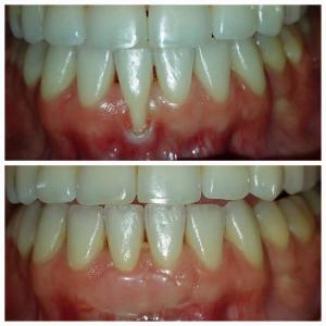Gum Graft
