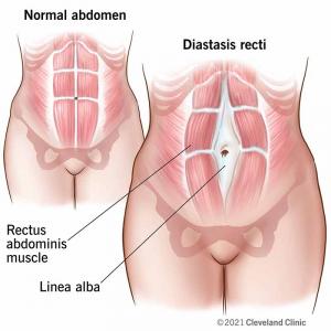 Medical illustration comparing normal abdominal muscles to diastasis recti, showing separation of rectus abdominis and stretched linea alba—used to explain postpartum core recovery at CoreLife Wellness.