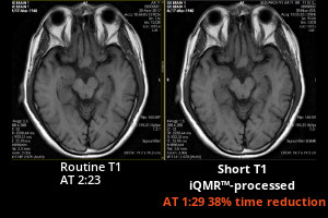 Medic Vision iQMR 38% brain MRI scan time reduction