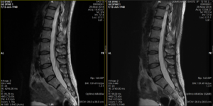 Medic Vision iQMR 47% spine MRI scan-time reduction