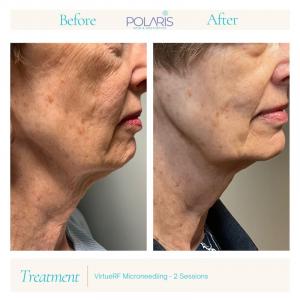 Visible improvement in skin laxity and texture after just two sessions of VirtueRF Microneedling. This advanced radiofrequency treatment stimulates collagen production, resulting in a smoother, firmer jawline and revitalized skin tone.