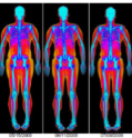 Color coded image of a DEXA Body Comp