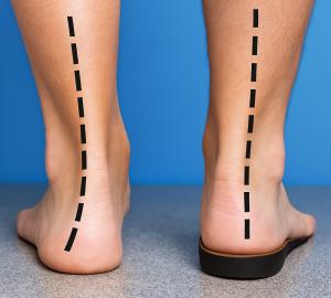 Custom Made Foot Insoles
