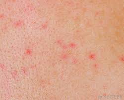 Genital Herpes Market Epidemiology Report