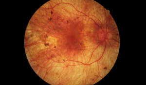 Choroideremia Market Epidemiology Forecast