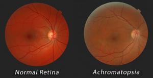 Achromatopsia Market Forecast