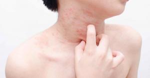 Chronic Urticaria Market Epidemiology Report