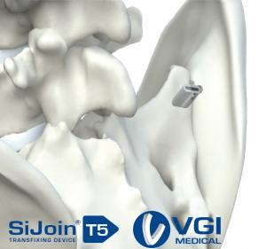 Image showing the SiJoin T5 device transfixing the sacroiliac joint at the superior articular surface.