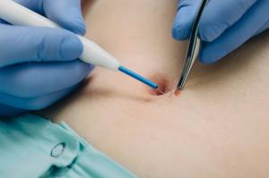 Close-up of a skincare professional performing a lesion removal procedure on the stomach area