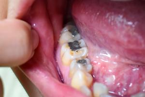 Silver amalgam fillings in an open mouth.