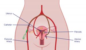 The UFE procedure is done by an IR physician that guides a catheter through an artery and injects tiny particles that blocks blood flow from the fibroid and causes it to shrink and die off.