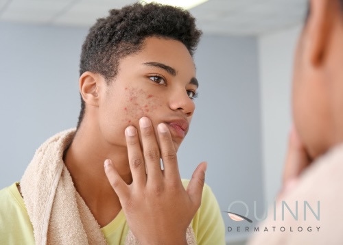 Back-to-School Acne Support, Quinn Dermatology
