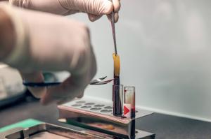 Close-up of gloved hands preparing platelet-rich fibrin (PRF) for use in a regenerative medicine treatment.