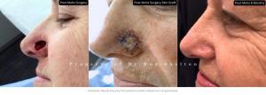 Mohs surgery in NYC before and after