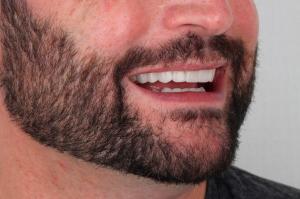 Minimally Invasive Veneers in Puerto Vallarta, Mexico