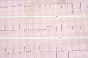Atrial Fibrillation Market (Product Type - Access Devices, Cardiac Monitors, EP Ablation Catheters, EP Diagnostic Catheters, EP Mapping & Recording Systems, LAA Closure, and Other Products; End-user - Hospitals, Electrophysiology Labs, and Ambulatory Surg