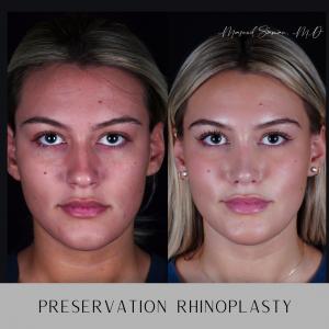 Before and after frontal view of rhinoplasty performed by one of the best rhinoplasty surgeons Dr. Masoud Saman in New York City, highlighting natural, elegant, and refined results.