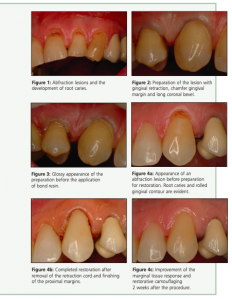 Paper by Dr. Peter Taylor - How to restore abfraction lesions- in a predictable and aesthetic manner
