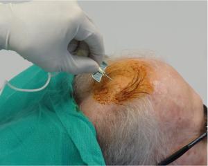 This is how the stem cells are injected directly into the brain.