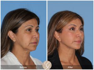 https://drkevinsadati.com/gallery/facelift/deep-plane-facelift/item/Qq_EO-ywTnS1CMxpSPcz-g/