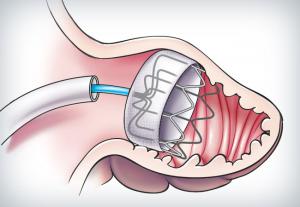 Left Atrial Appendage Closure Device Market