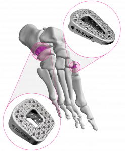 The ARKEO™ implant.