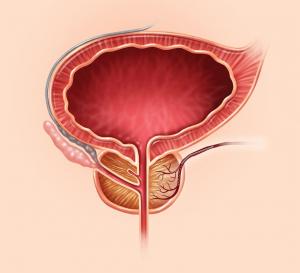 PAE is performed by Tiny microspheres are injected to the arteries that supply the prostate gland which partially blocks the flow of blood to the gland.
