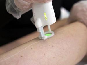 Laser Hair Removal