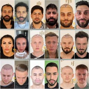 Natural hairline and density achieved through Sule Hair Transplant’s AI-powered Hybrid FUE-DHI technique.