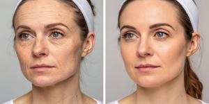 vitamin C before and after