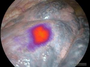 In Situ Lung Cancer Adenocarcinoma