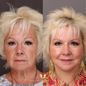 Utah Facial Plastics - Before and After Facial Plastic Surgery
