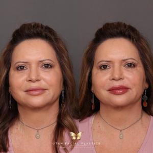 Lip Filler at Utah Facial Plastics by Moriah