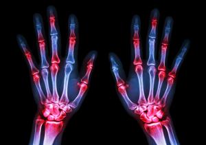 In-home senior care services and Senior arthritis hand xray